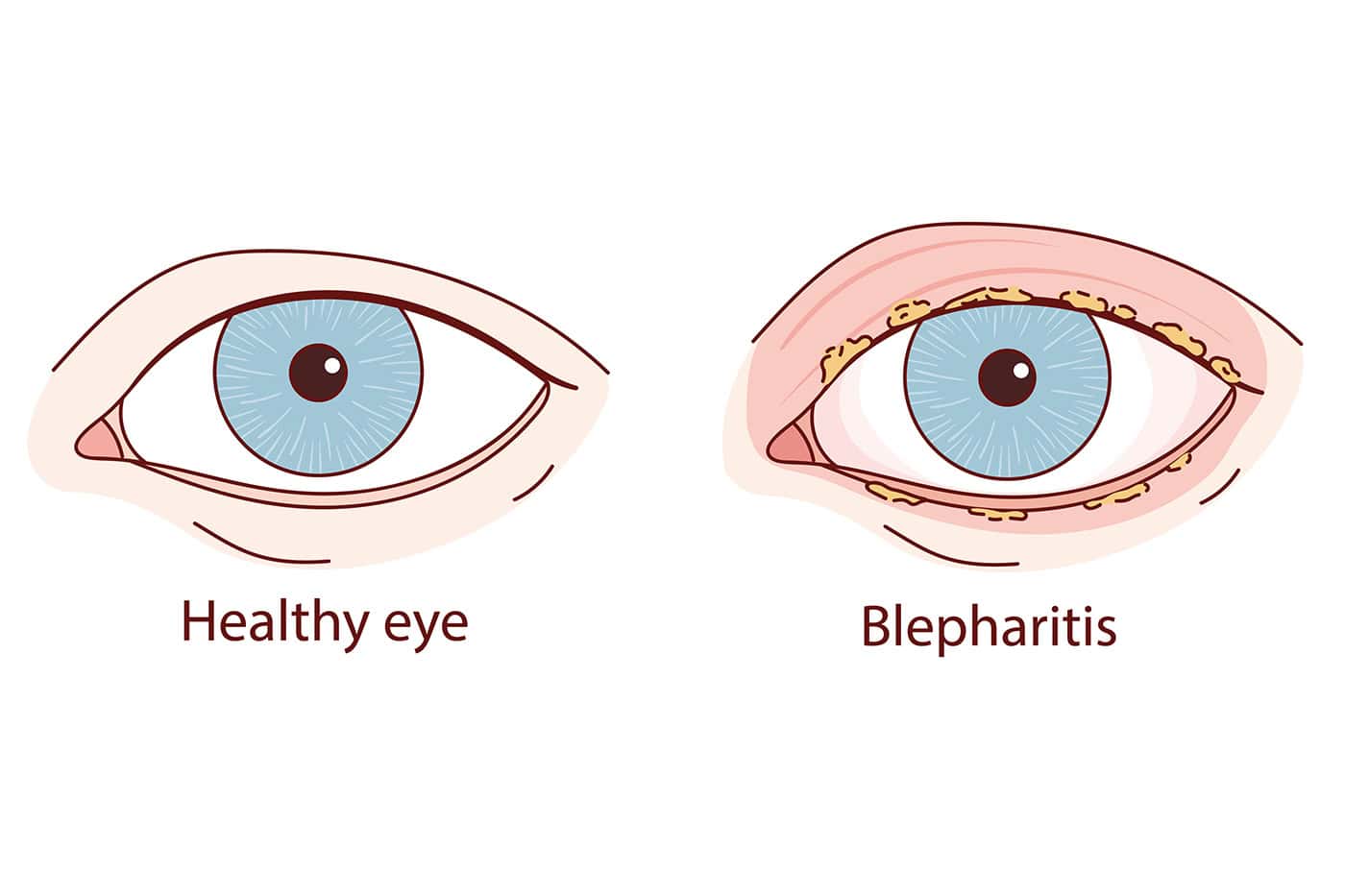 Healthy Eye vs Eye With Stye